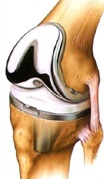 protesi_ginocchio